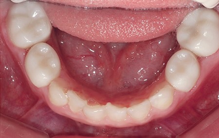 Στεφάνες Ζιρκονίου σε Όλα τα Οπίσθια Δόντια