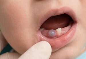 Κύστη Ανατολής